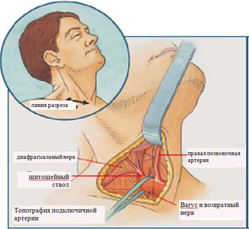Хирургический доступ и топографическая анатомия подключично-позвоночного сегмента Хирургический доступ и топографическая анатомия подключично-позвоночного сегмента