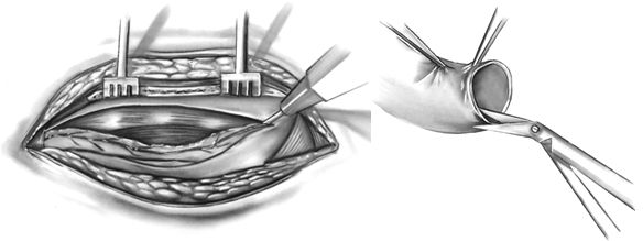 Выделение и подготовка для дистального анастомоза внутренней грудной артерии Выделение и подготовка для дистального анастомоза внутренней грудной артерии