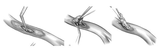 Закрытая эндартериэктомия Закрытая эндартериэктомия