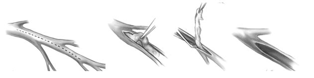 Открытая эндартериэктомия Открытая эндартериэктомия