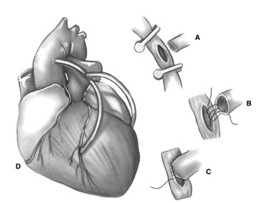 Формирование композитных кондуитов Формирование композитных кондуитов