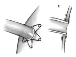 Бесшовный проксимальный коннектор Бесшовный проксимальный коннектор