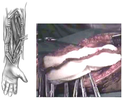 Выделение лучевой артерии Выделение лучевой артерии