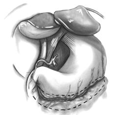 Выделение правой желудочно-сальниковой артерии Выделение правой желудочно-сальниковой артерии