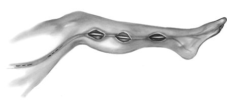 Выделение большой подкожной вены Выделение большой подкожной вены