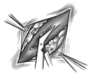 Коронарная артериотомия Коронарная артериотомия