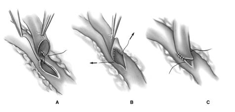 Формирование дистального анастомоза Формирование дистального анастомоза