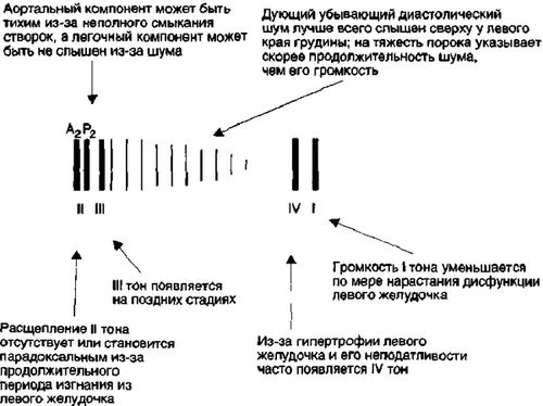 Аускультативная картина аортальной недостаточности Аускультативная картина аортальной недостаточности