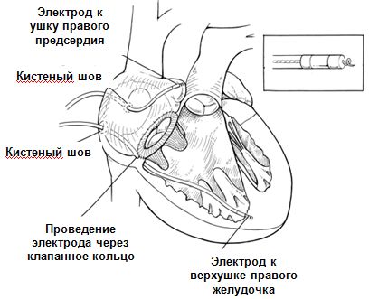 Двухкамерная стимуляция правых отделов сердца Двухкамерная стимуляция правых отделов сердца