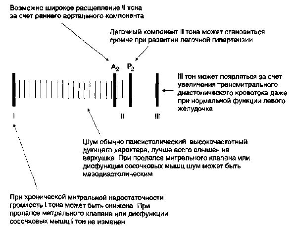 Аускультативные признаки митральной недостаточности