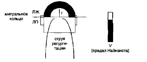 Эхо-КГ оценка тяжести митральной регургитации