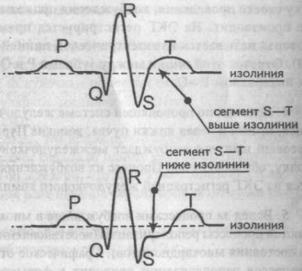 Сегмент S—Т выше и ниже изолинии Сегмент S—Т выше и ниже изолинии
