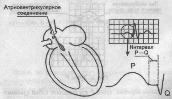 Интервал Р—Q Интервал Р—Q