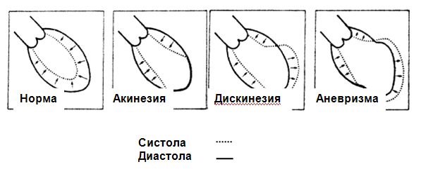 .Схематическое изображение формирования аневризмы левого желудочка .Схематическое изображение формирования аневризмы левого желудочка