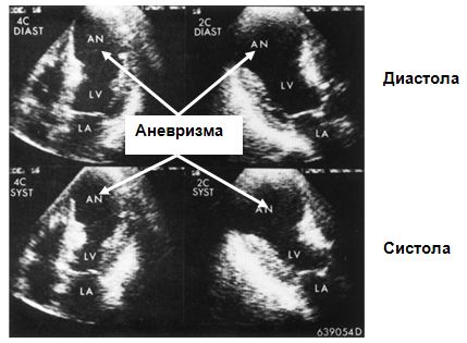 Эхокардиографическое изображение аневризмы левого желудочка Эхокардиографическое изображение аневризмы левого желудочка