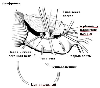 Схема левопредсердно-аортального обхода Схема левопредсердно-аортального обхода