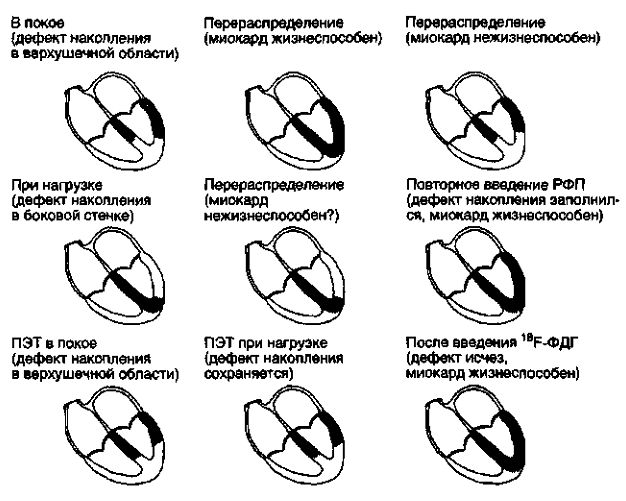 Изотопные методы выявления жизнеспособного миокарда