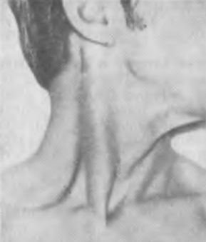 Анатомические ориентиры для пункции внутренней яремной вены Анатомические ориентиры для пункции внутренней яремной вены