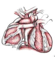 Гетеротопическая пересадка сердца Гетеротопическая пересадка сердца