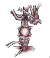 Методика Shumway-Lower Методика Shumway-Lower