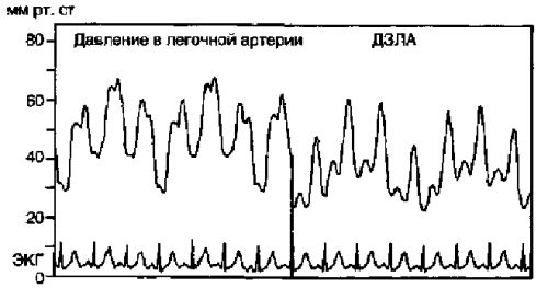 Кривые давления в легочной артерии и ДЗЛА при острой митральной недостаточности Кривые давления в легочной артерии и ДЗЛА при острой митральной недостаточности