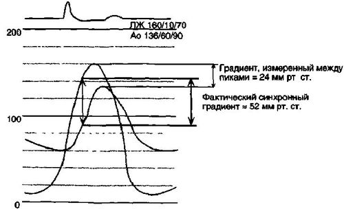 Аортальный стеноз Аортальный стеноз