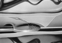 Коронарная ангиопластика Коронарная ангиопластика