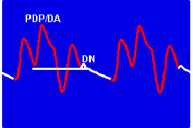 Кривая АД при работе ВАБК. PDP/DA – пиковое диастолическое давление как результат «диастолического усиления», DN – дикротический зубец Кривая АД при работе ВАБК. PDP/DA – пиковое диастолическое давление как результат «диастолического усиления», DN – дикротический зубец